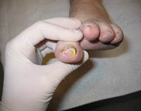 nagelbeugel_0 nagelbeugel_0